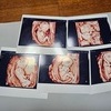 다섯쌍둥이 출산 부부, 1억 7000만 원 넘게 지원받는다